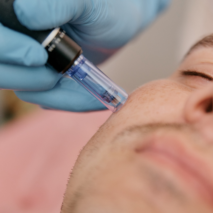 microneedling capitol hill