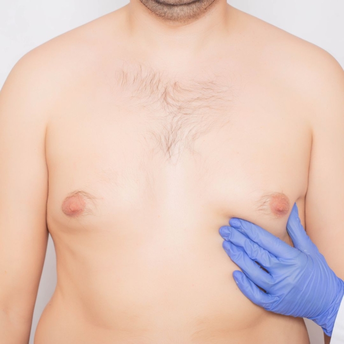 Male Breast Reduction DC