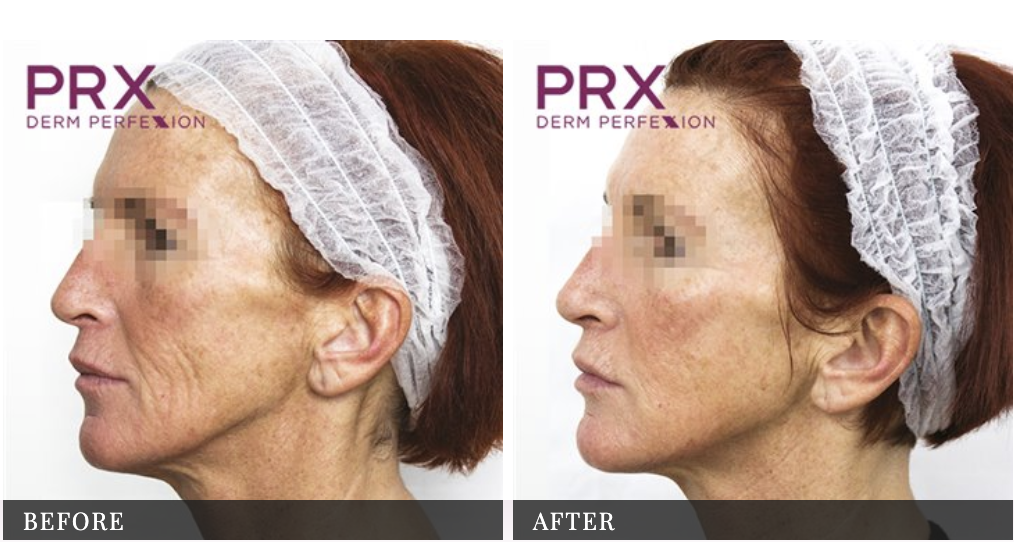 prx skin treatment in washington dc